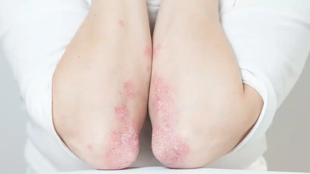 Autoimmune Progesterone Dermatitis